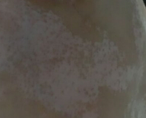 武汉腿部白癜风的症状需要如何注意呢？